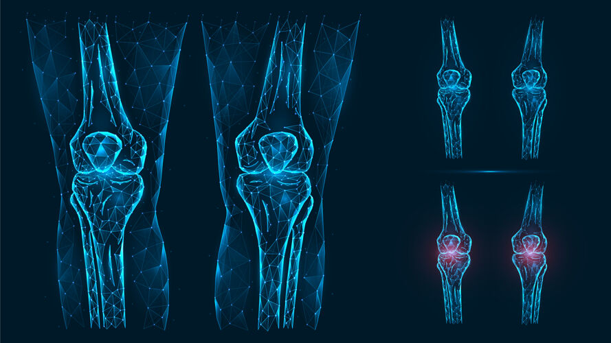 多边形人体膝盖的抽象多边形插图解剖学.疾病 膝关节的疼痛和炎症骨骼线框骨骼