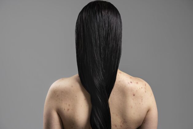 粉刺年轻的女人在她的肩膀上显示痤疮问题自我护理皮肤科