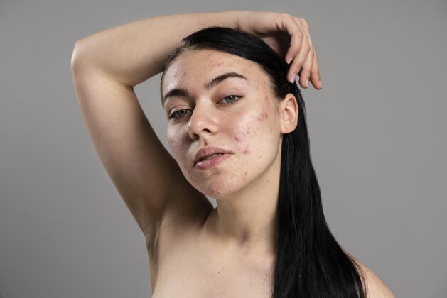 肖像年轻女子自信地露出她的粉刺毛孔面部皮肤科