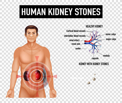 病理学在透明背景上显示人类肾结石的示意图人物透明信息图